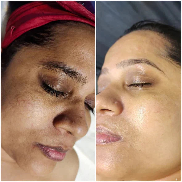✨Fast Dark Spot Remover-AQA™  Melanin Correcting Facial Serum(🔥Last Day Promotion 60% OFF)