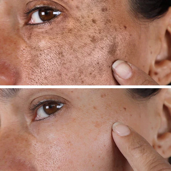 ✨Fast Dark Spot Remover-AQA™  Melanin Correcting Facial Serum(🔥Last Day Promotion 60% OFF)
